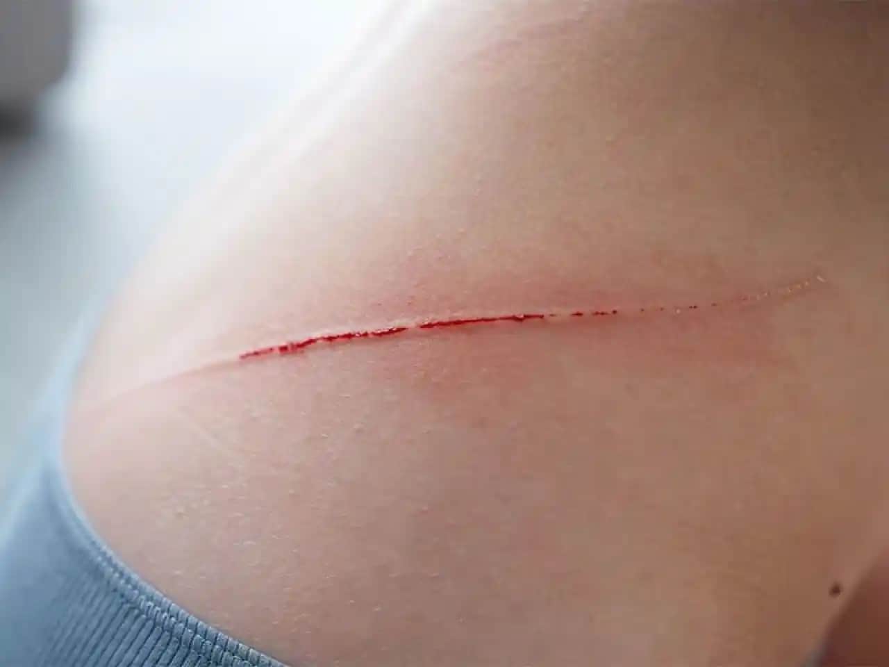 Yara İzlerine İyi Gelen Doğal Yağlar ve Etkili Kullanım Yöntemleri