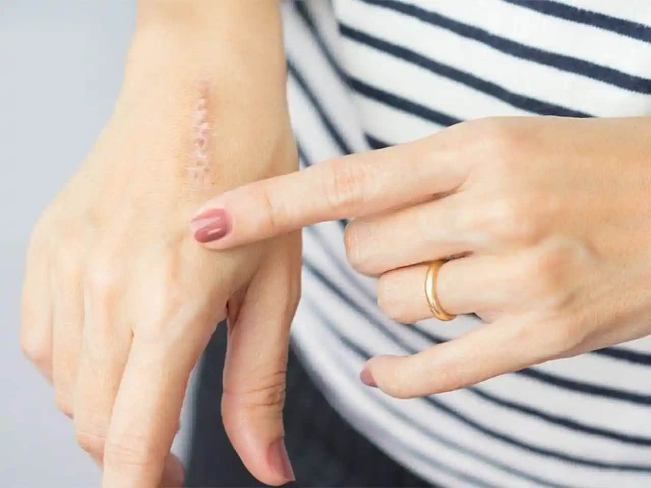 Yara Şişliği Ne İyi Gelir Cilt Sağlığını Koruma Rehberi