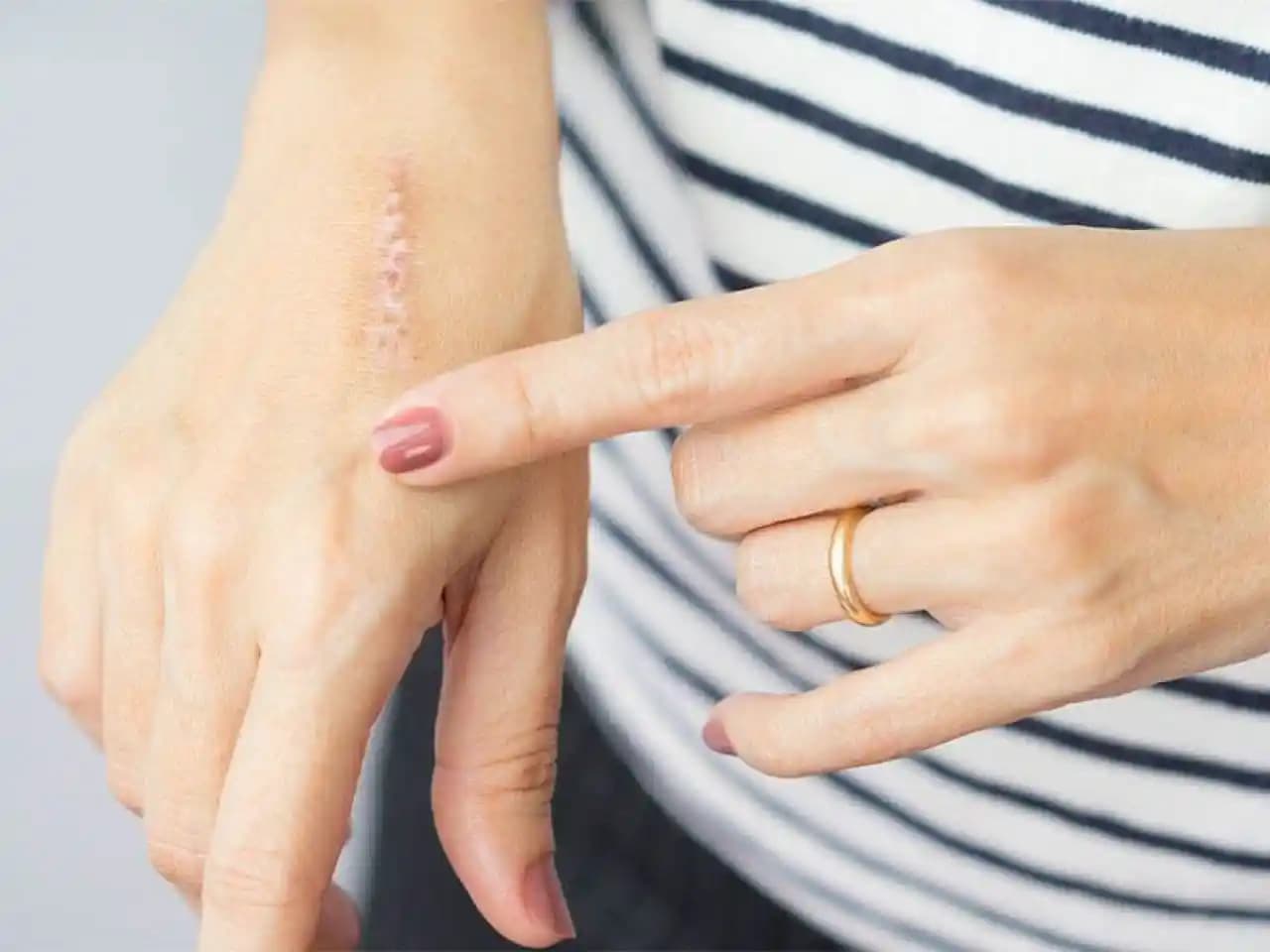 Yara Şişliği Ne İyi Gelir Cilt Sağlığını Koruma Rehberi