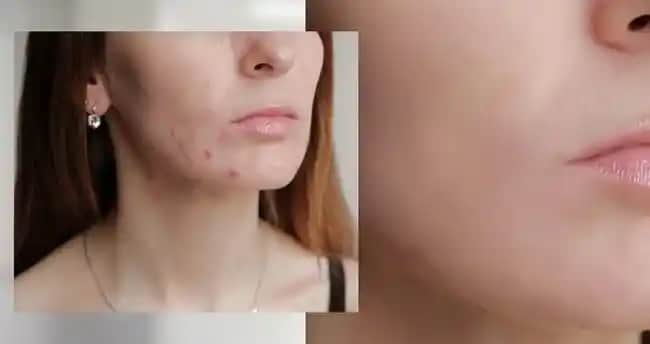 Yeni Çıkmaya Başlayan Sivilcelere Karşı Etkili Doğal ve Kozmetik Çözümler