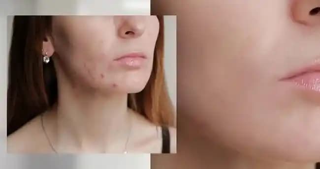 Yeni Çıkmaya Başlayan Sivilcelere Karşı Etkili Doğal ve Kozmetik Çözümler