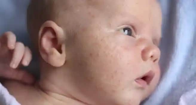 Yeni Doğan Bebeklerin Yüzündeki Sivilceler Nasıl Geçer ve Doğru Bakım Yöntemleri