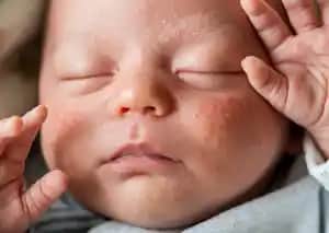 Yenidoğan Aknesi Nedir, Nedenleri ve Bebek Cilt Sağlığı İçin Öneriler