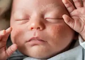 Yenidoğan Aknesi Nedir, Nedenleri ve Bebek Cilt Sağlığı İçin Öneriler