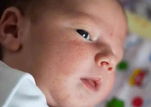 Yenidoğan Sivilcesi Nedenleri ve Doğru Bakım Yöntemleri Hakkında Bilgi