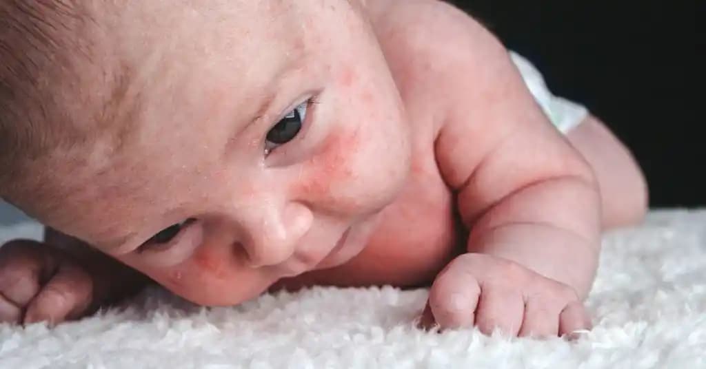 Yenidoğanlarda Beyaz Noktalar: Nedenleri ve Güvenli Bakım Yöntemleri