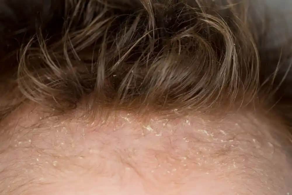 Yetişkinlerde Saçta Konak Nedir, Belirtileri ve Etkili Çözüm Yöntemleri