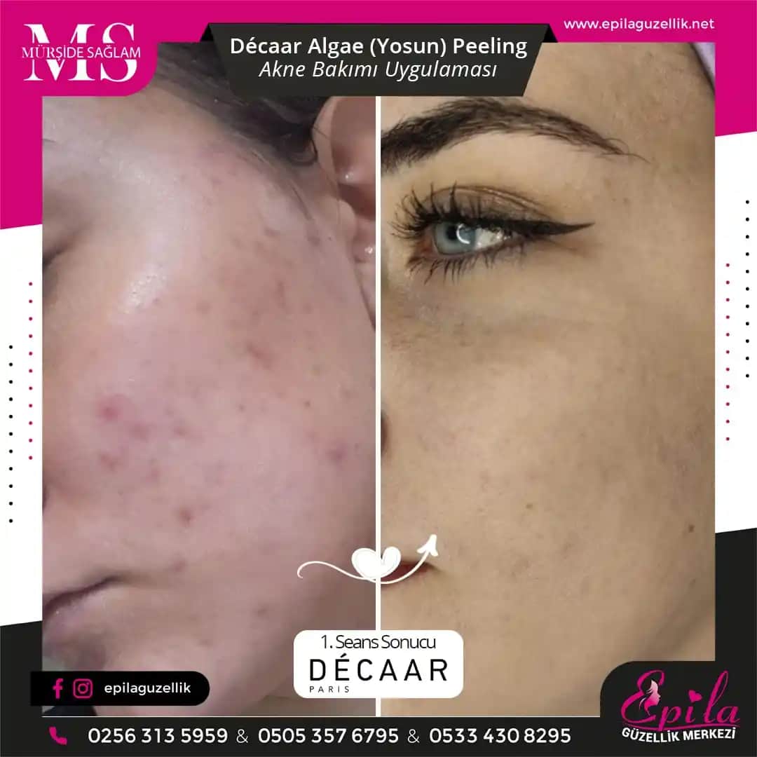 Yosun Peelingi Nedir? Doğal Güzellik ve Cilt Sağlığı İçin Etkili Bir Yöntem