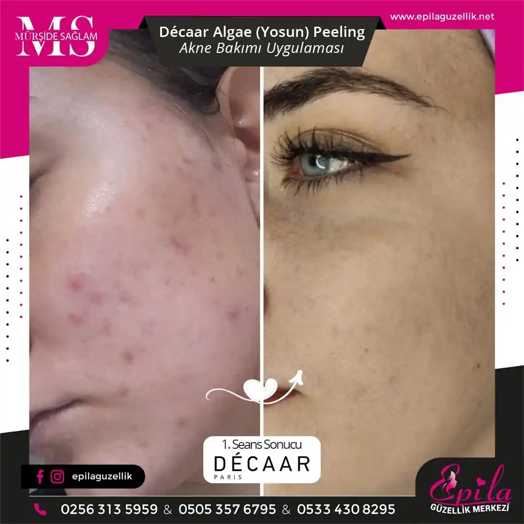 Yosun Peelingi Nedir? Doğal Güzellik ve Cilt Sağlığı İçin Etkili Bir Yöntem