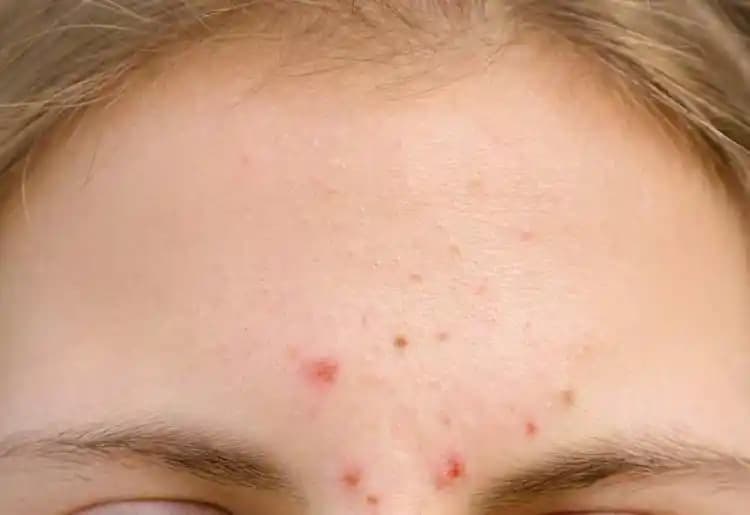 Yüz Kenarında Çıkan Sivilceler: Nedenleri ve Etkili Çözüm Yöntemleri