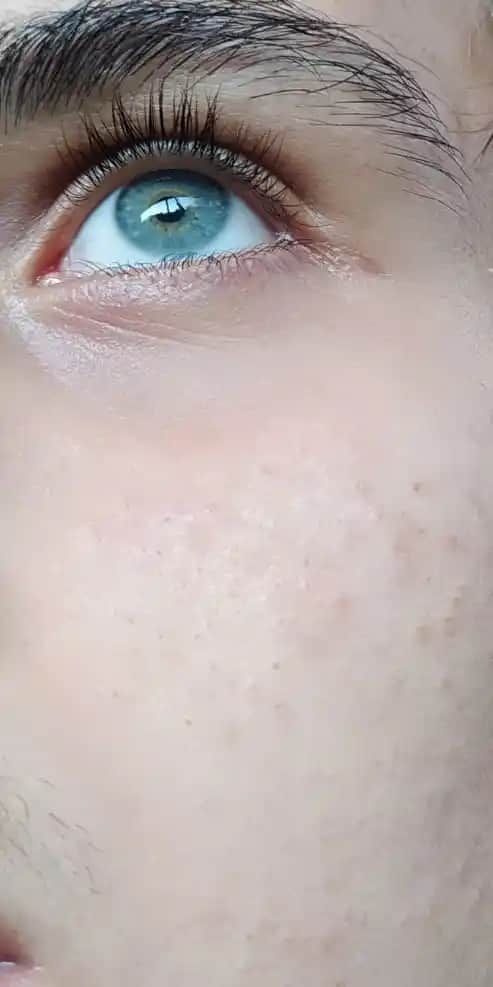 Yüzde 1'den Sivilcelenmenin Nedenleri ve Etkili Çözüm Yöntemleri