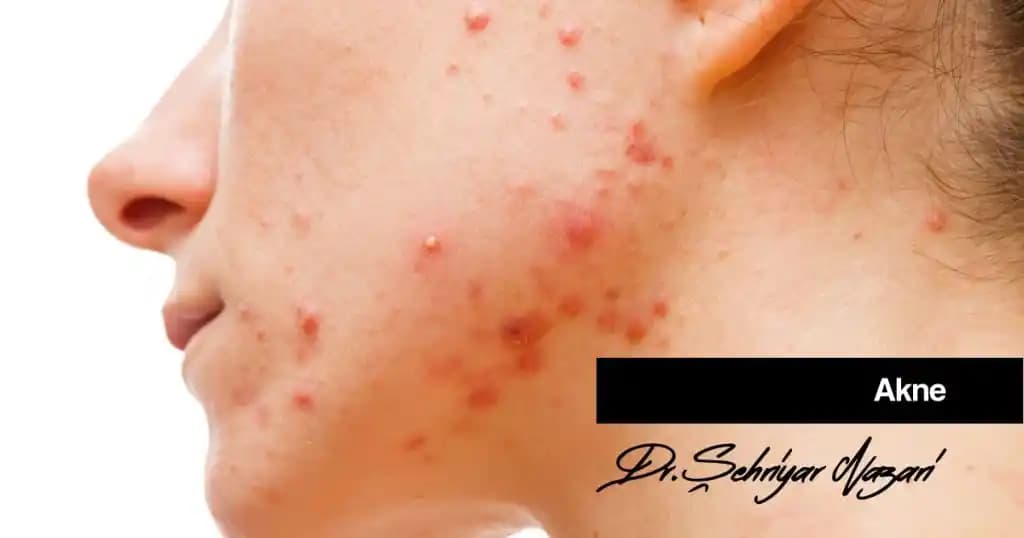 Yüzde Akne Nedenleri, Çeşitleri ve Etkili Tedavi Yöntemleri Hakkında Bilmeniz Gerekenler