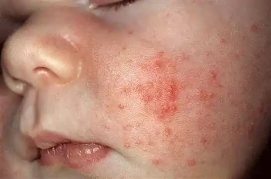 Yüzde Alerjik Egzama: Belirtiler, Nedenler ve Etkili Koruma Yöntemleri