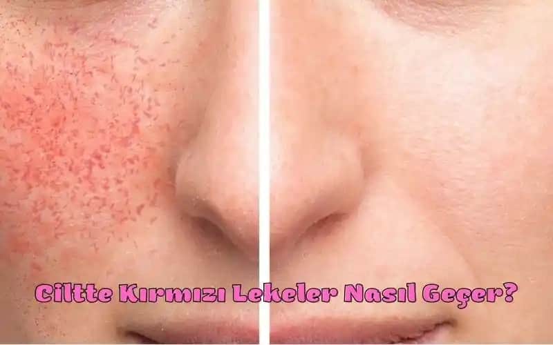 Yüzde Aniden Çıkan Kırmızı Lekelerin Nedenleri ve Etkili Çözüm Yolları