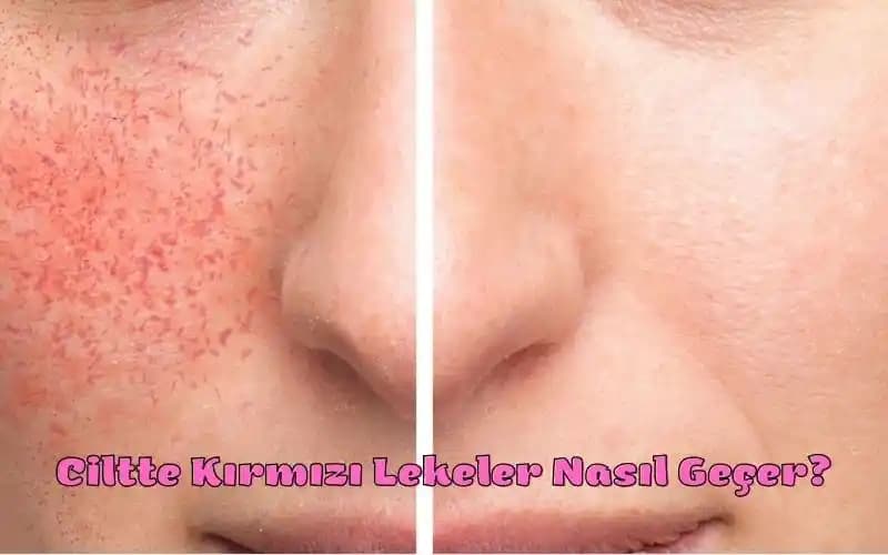 Yüzde Aniden Çıkan Kırmızı Noktaların Nedenleri ve Çözüm Yolları Hakkında Bilgilendirici Rehber