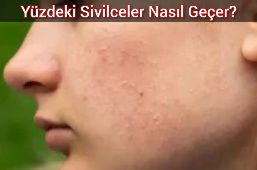 Yüzde Çıkan Büyük Sivilceleri Doğru Yöntemlerle Nasıl Geçirirsiniz