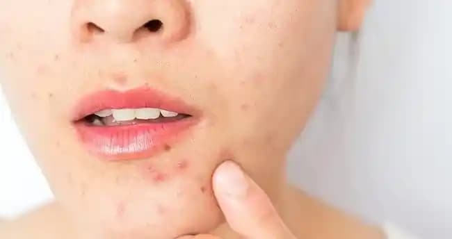 Yüzde Çıkan Sivilcelere Karşı Etkili Doğal ve Klinik Çözüm Yöntemleri