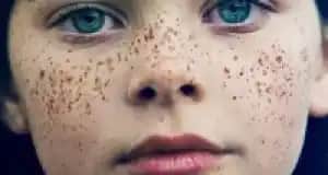 Yüzde Çil Nedenleri ve Gelişimi: Cilt Sağlığı ve Estetik İçin Bilinmesi Gerekenler