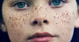 Yüzde Çil Nedenleri ve Gelişimi: Cilt Sağlığı ve Estetik İçin Bilinmesi Gerekenler