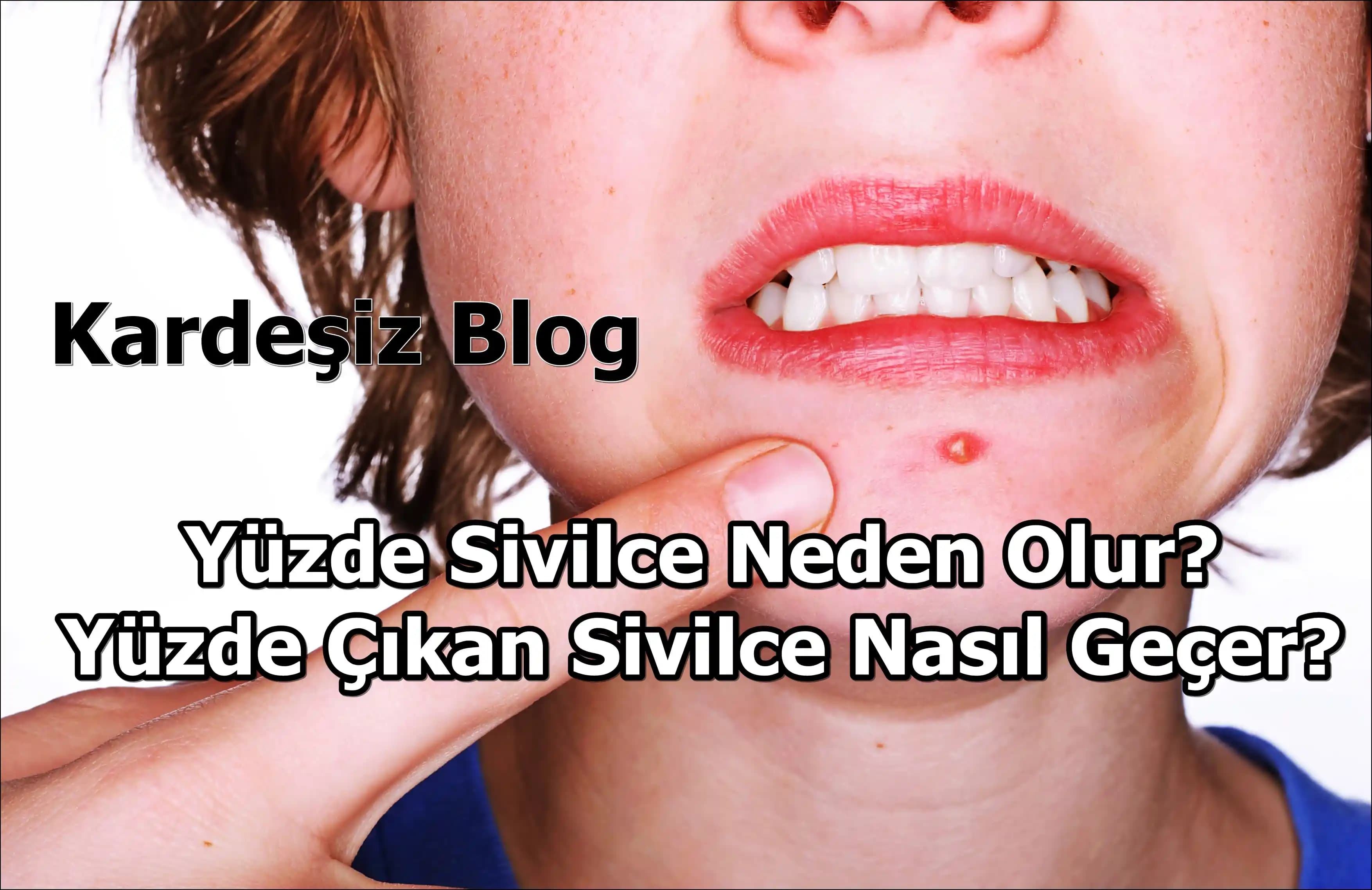 Yüzde Çok Sivilce Çıkmasının Nedenleri ve Etkili Çözüm Yolları