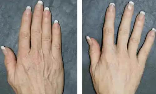 Yüzde Damar Genişlemesi Nedenleri ve Etkili Tedavi Yöntemleri Hakkında Bilgi