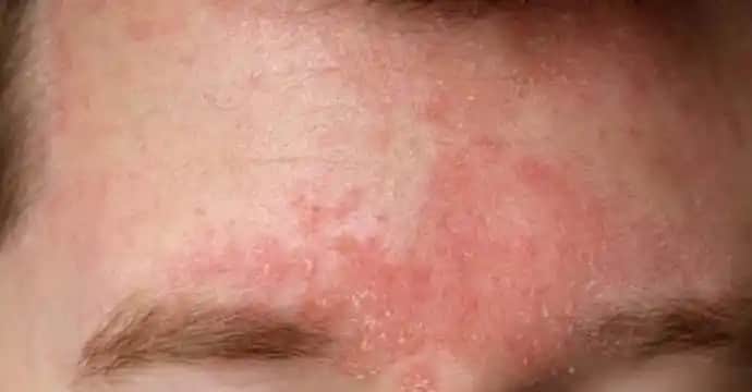 Yüzde Egzema Nedir, Nedenleri ve Etkili Bakım Yöntemleri Hakkında Bilgiler