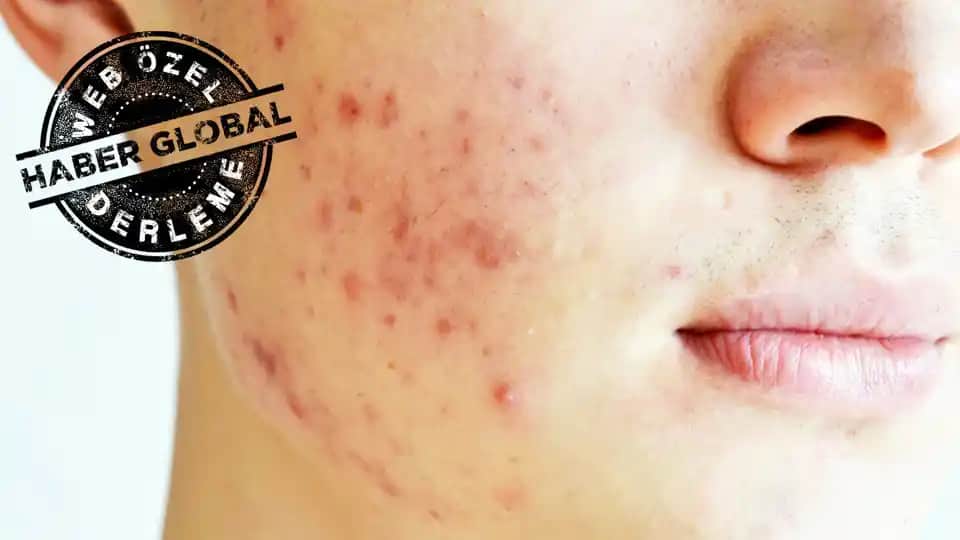 Yüzde Kaşıntılı Sivilce Nedenleri Belirtileri ve Etkili Çözüm Yolları