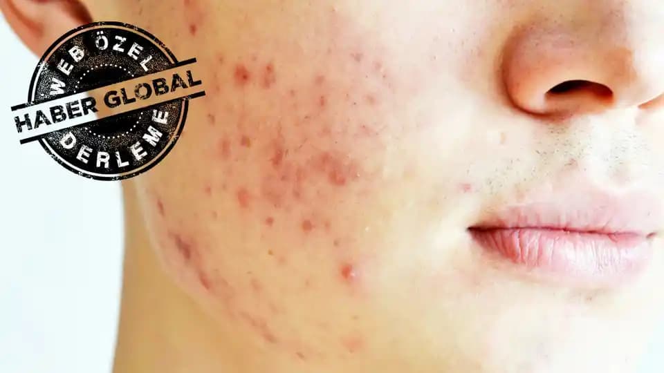 Yüzde Kaşıntılı Sivilce Nedenleri Belirtileri ve Etkili Çözüm Yolları