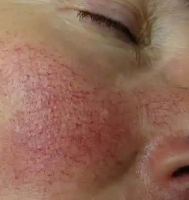 Yüzde Kılcal Damar Çatlaması Nedenleri Belirtileri ve Etkili Tedavi Yöntemleri