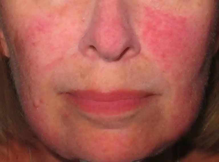 Yüzde Kırmızı Leke Nedenleri, Tedavi Yöntemleri ve Cilt Bakımı İpuçları