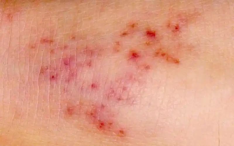 Yüzde Kırmızı Lekelerin Nedenleri ve Doğal Çözüm Yolları