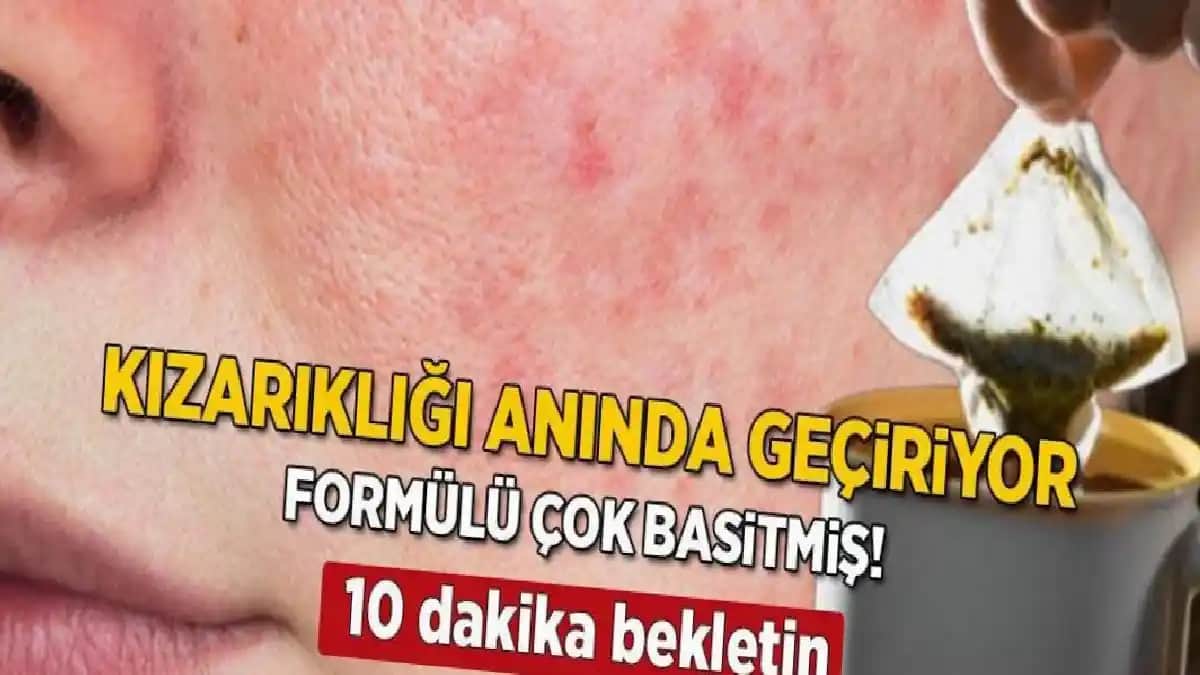Yüzde Kızarıklık ve Kuruluk İçin Etkili Kozmetik Bakım Yöntemleri ve Çözüm Önerileri