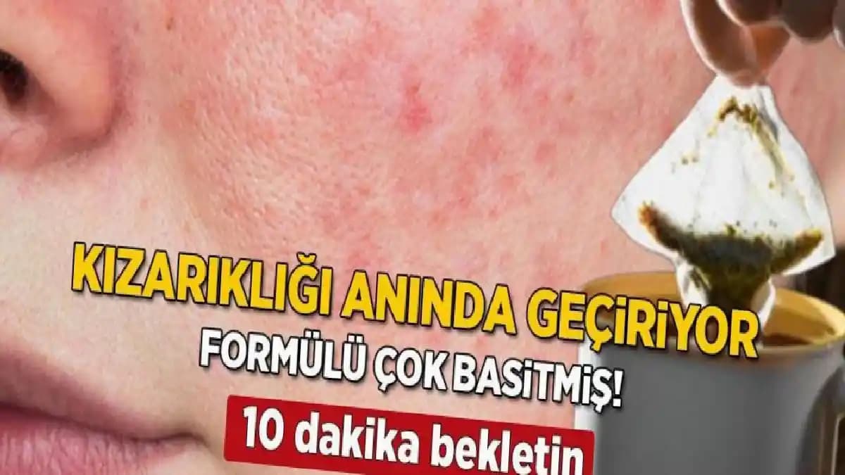 Yüzde Kızarıklık ve Kuruluk İçin Etkili Kozmetik Bakım Yöntemleri ve Çözüm Önerileri