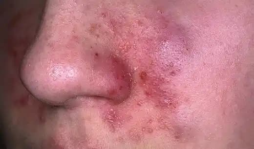 Yüzde Kızarıklık ve Pullanmanın Nedenleri, Çözümleri ve Bakım Önerileri