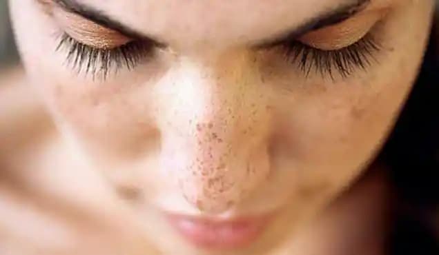 Yüzde Leke Hastalığı ve Güncel Çözüm Yaklaşımları