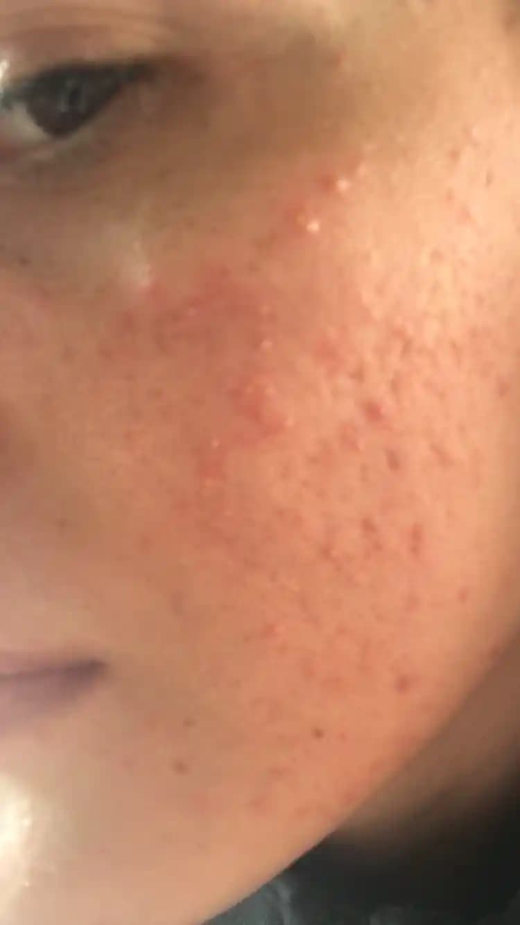 Yüzde Mantar ve Sivilce İlişkisi: Belirtiler, Çözümler ve Cilt Bakım Önerileri