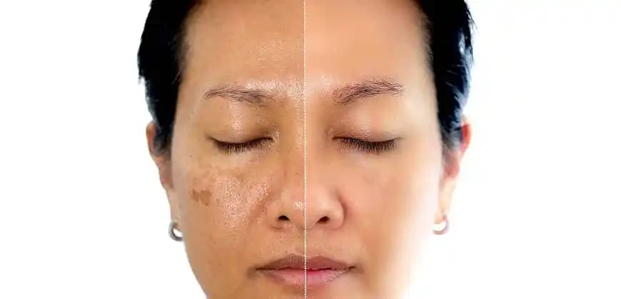 Yüzde Oluşan Lekeler ve Çözüm Yolları: Etkili Tedavi ve Bakım Yöntemleri