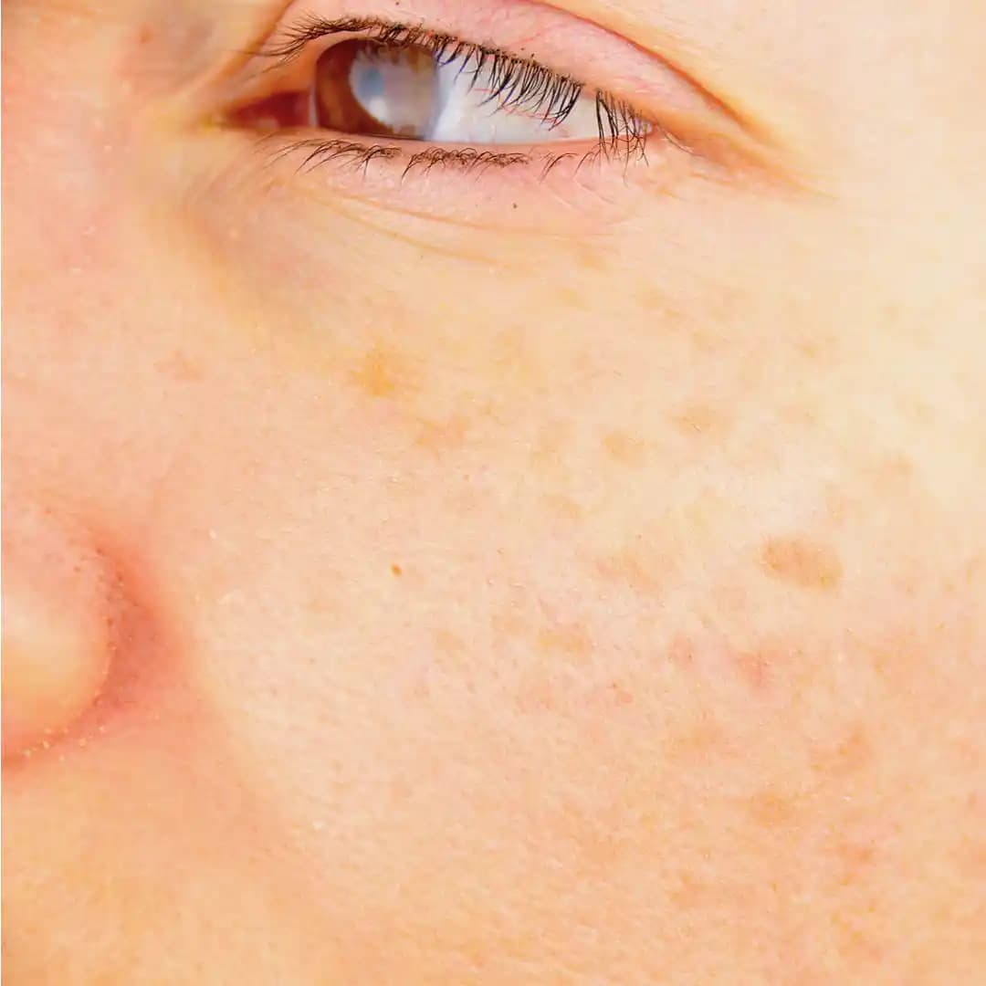 Yüzde Sarı Leke Nedenleri, Tedavi Yöntemleri ve Kozmetik İpuçları