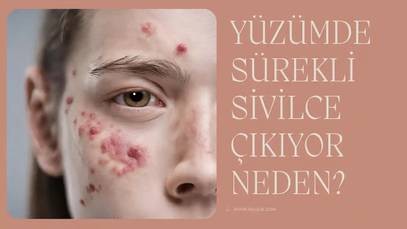 Yüzde Sivilce Oluşumunun Nedenleri ve Etkili Çözüm Yöntemleri