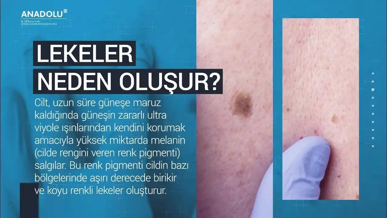 Yüzde Siyah Lekelerin Nedenleri ve Etkili Çözüm Yöntemleri