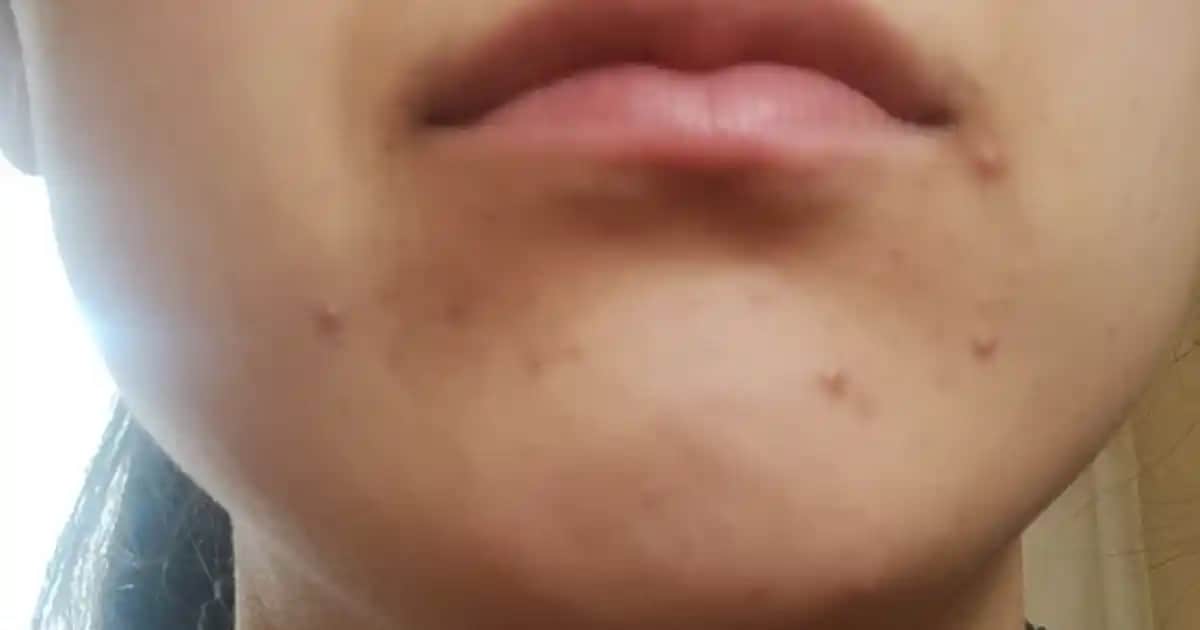 Yüzde Sürekli Sivilce Çıkmasının Nedenleri ve Etkili Çözüm Yolları