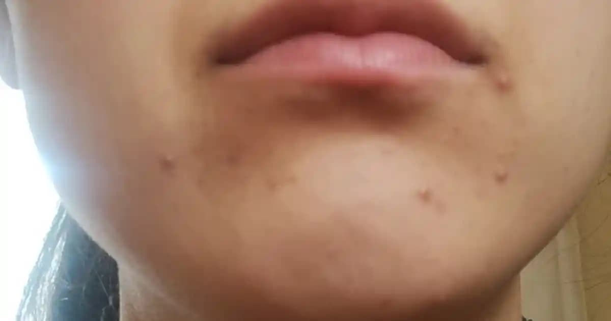 Yüzde Sürekli Sivilce Çıkmasının Nedenleri ve Etkili Çözüm Yolları