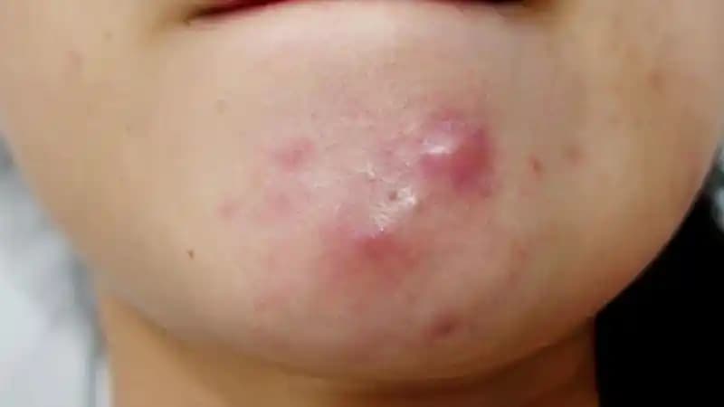 Yüzde Ucu Olmayan Sivilceler ve Etkili Tedavi Yöntemleri