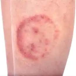 Yüzde Yuvarlak Kızarıklıkların Nedenleri ve Etkili Tedavi Yöntemleri