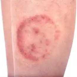 Yüzde Yuvarlak Kızarıklıkların Nedenleri ve Etkili Tedavi Yöntemleri