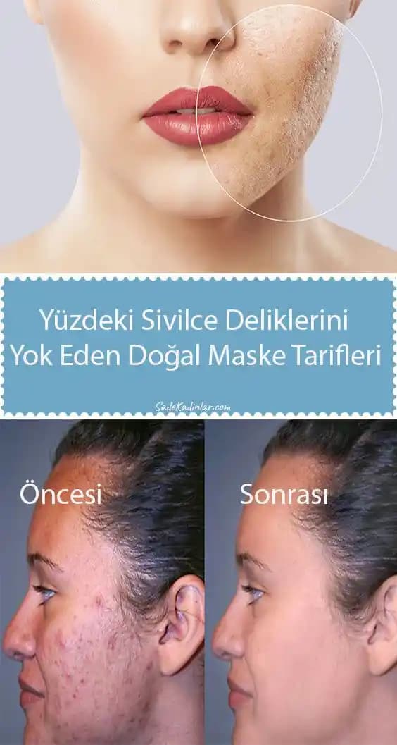 Yüzdeki Akne İçin Etkili Tedavi Yöntemleri ve Uzman Tavsiyeleri