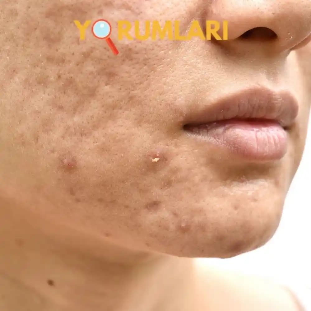Yüzdeki Akne Nedenleri, Çözüm Yolları ve Doğal Yaklaşımlar Hakkında Kapsamlı Rehber