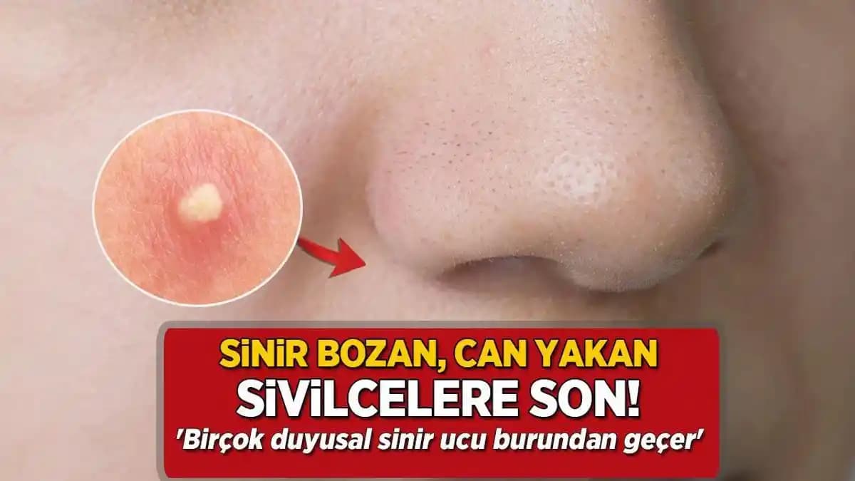 Yüzdeki Büyük Sivilcelerin Nedenleri, Çözümleri ve Bakım Tavsiyeleri