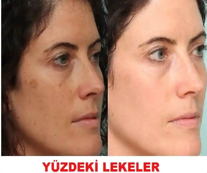 Yüzdeki Cilt Lekelerinin Nedenleri Türleri ve Etkili Çözüm Yolları