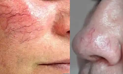 Yüzdeki Damarların Belirgin Olmasının Nedenleri ve Kozmetik Çözüm Yöntemleri